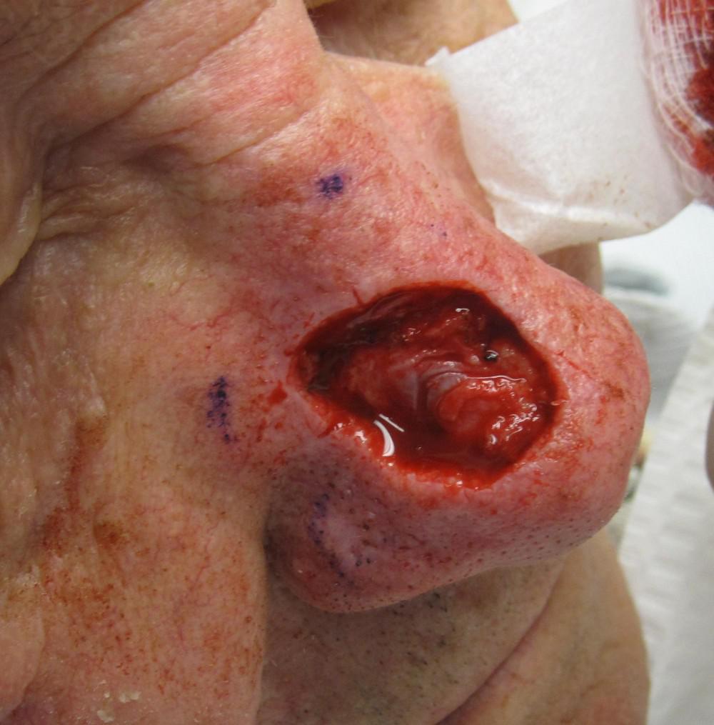 Basal Cell Carcinoma | Pine Belt Dermatology