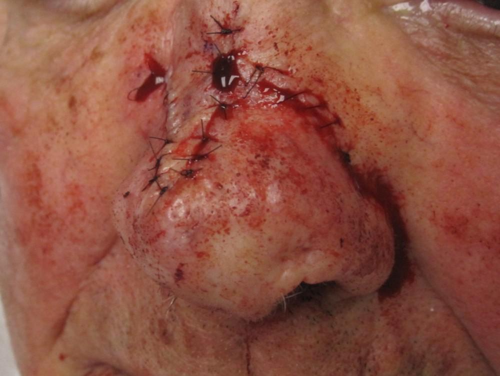 Stitches after micronodular basal cell carcinoma | Pine Belt Dermatology