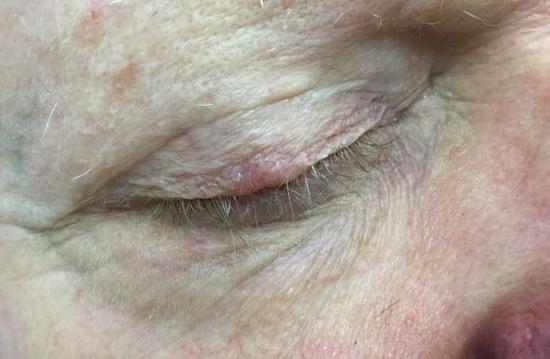 Surgery Case | Pine Belt Dermatology
