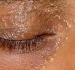 Mohs Basal Cell | Treatment | Pine Belt Dermatology