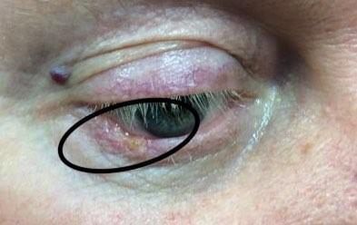 Carcinoma Treatment | Pine Belt Dermatology