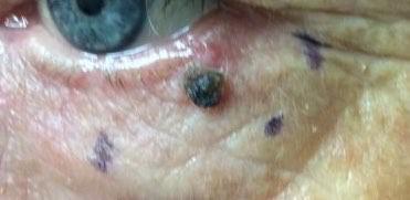 Mohs - Basal Cell Carcinoma | Pine Belt Dermatology