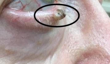 Mohs Surgery - Basal Cell | Pine Belt Dermatology