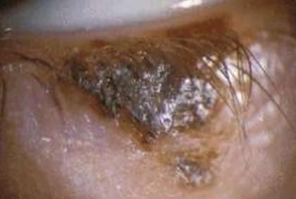 Mohs Surgery Case | Before Treatment | Pine Belt Dermatology