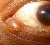 Mohs Surgery Case | Basal Cell Carcinoma | Pine Belt Dermatology