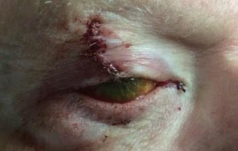 Basal Cell Carcinoma | Mohs Surgery | Pine Belt Dermatology
