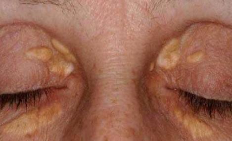 Carcinoma | Pine Belt Dermatology