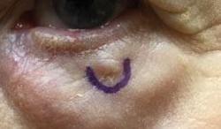 Mohs Surgery | Basal Cell | Pine Belt Dermatology