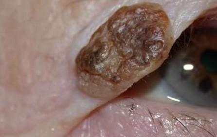 Basal Cell Carcinoma Treatment | Pine Belt Dermatology