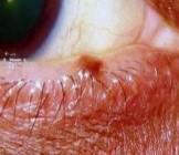 Mohs Surgery Basal Cell Carcinoma Treatment | Pine Belt Dermatology