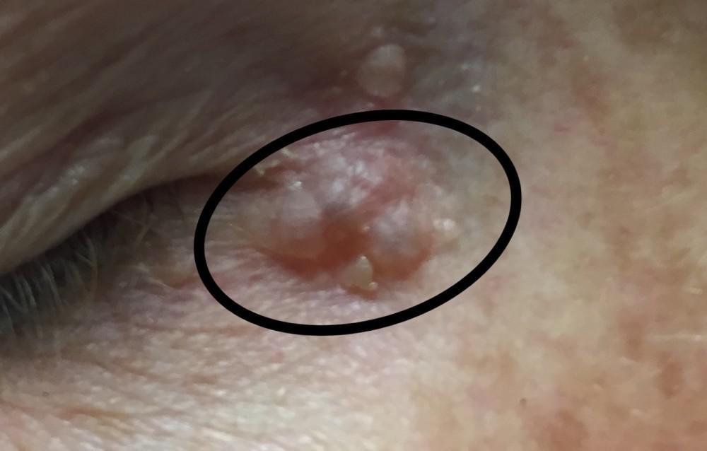 Basal Cell Treatment | Pine Belt Dermatology