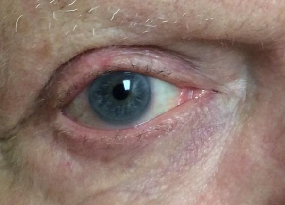 Basal Cell Carcinoma | Mohs | Pine Belt Dermatology