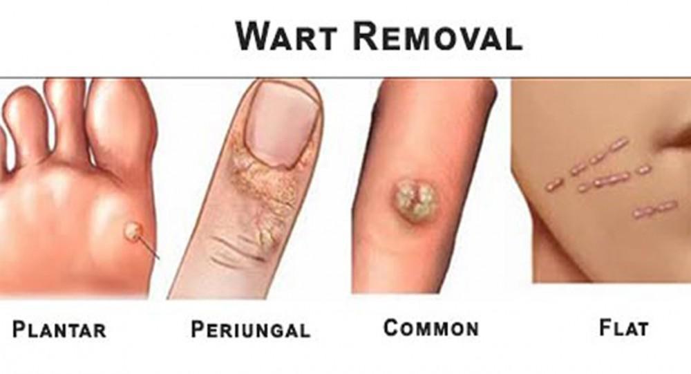 Warts and Treatment | Pine Belt Dermatology