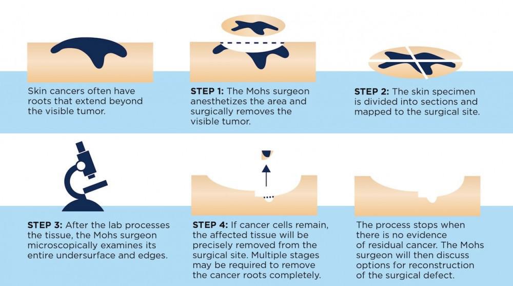 Mohs Micrographic Surgery Process | Pine Belt Dermatology