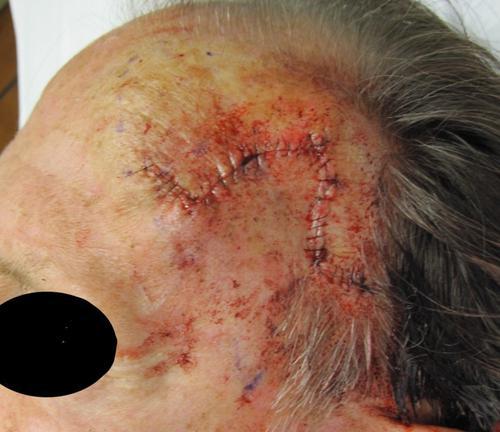 Mohs Micrographic Surgery | Right After Treatment | Pine Belt Dermatology