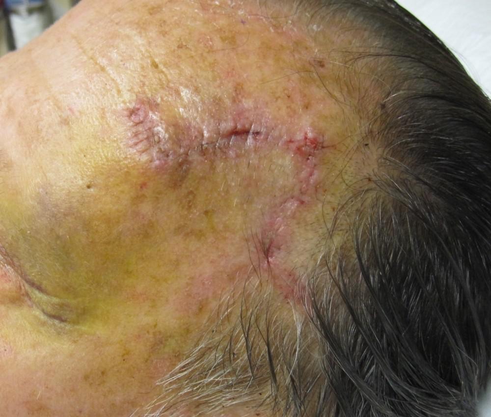 Mohs Micrographic Surgery Healing | Pine Belt Dermatology