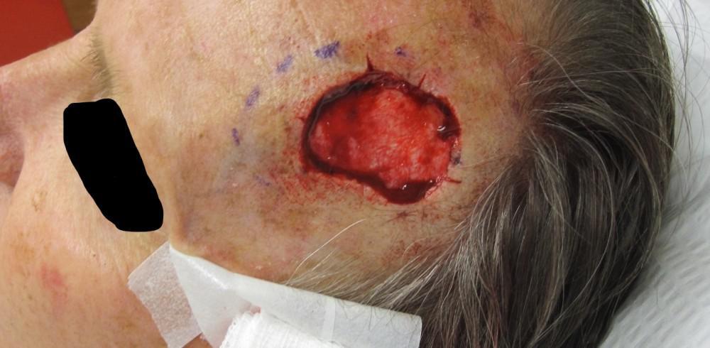 Mohs Micrographic Surgery | Pine Belt Dermatology