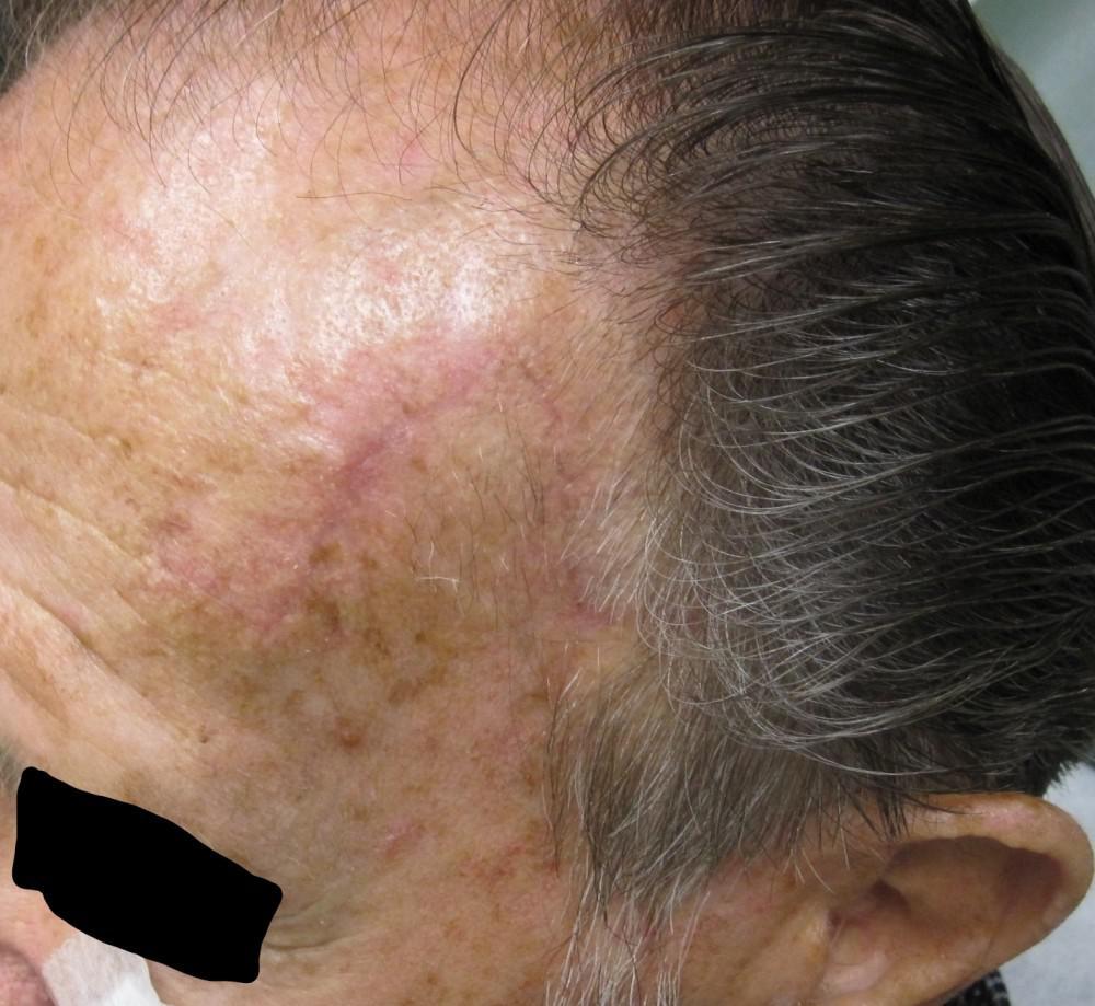 Mohs Micrographic Surgery | Healed | Pine Belt Dermatology