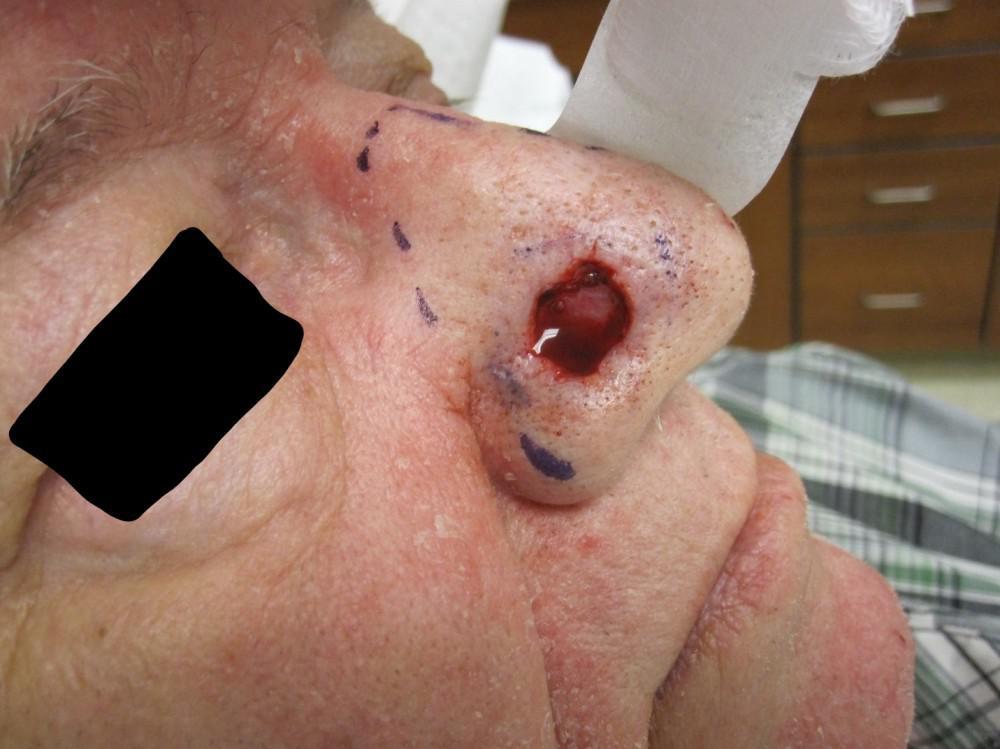 Mohs Surgery Case | Pine Belt Dermatology