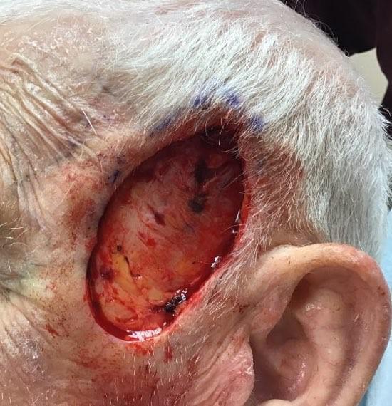Squamous Cell Carcinoma | Pine Belt Dermatology