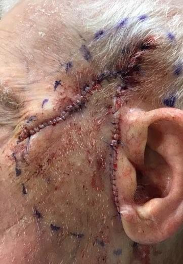 Squamous Cell Carcinoma Stitches | Pine Belt Dermatology