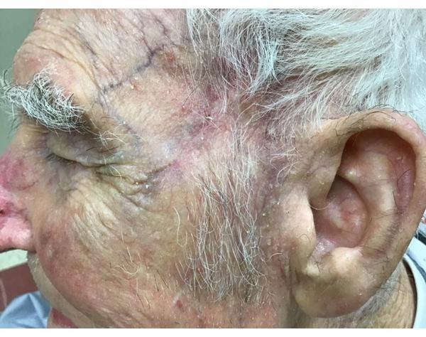 Squamous Cell Carcinoma Healed | Pine Belt Dermatology