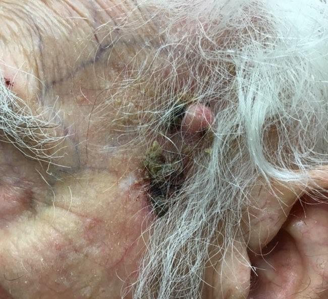 Squamous Cell Carcinoma before incision | Pine Belt Dermatology