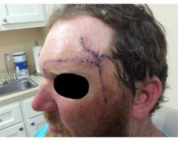 Recovery from Basal Cell Carcinoma | Pine Belt Dermatology