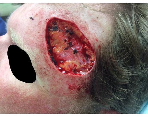 Recurring Basal Cell Carcinoma | Pine Belt Dermatology