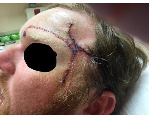 Stitches in head | Pine Belt Dermatology