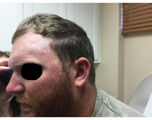 Basal Cell Carcinoma Healed | Pine Belt Dermatology