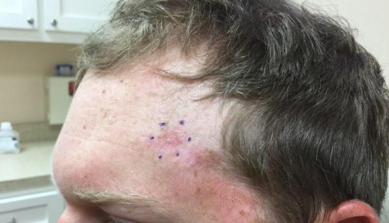 Mohs Case | Recurring Basal Cell | Pine Belt Dermatology