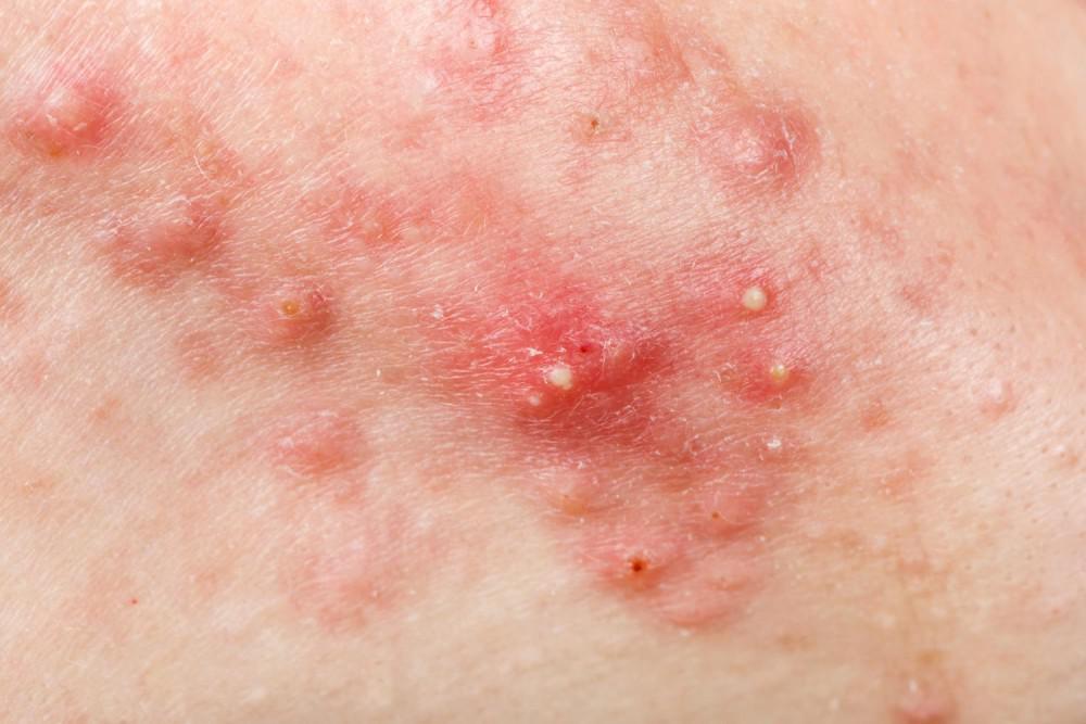Acne Treatment | Pine Belt Dermatology