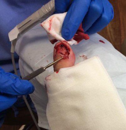 Nail Case of the Month | Pine Belt Dermatology