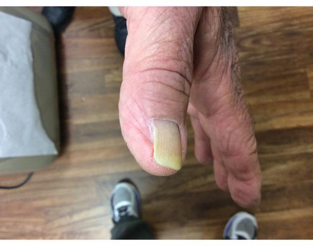 Nail Repair Healed | Pine Belt Dermatology