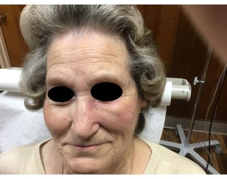 Healing Process on Nose | Pine Belt Dermatology
