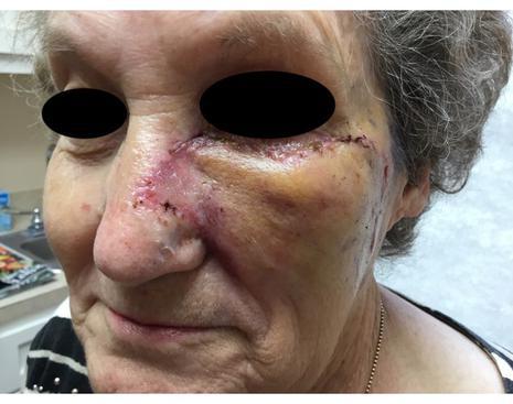 Case of the Month | Healing After Surgery | Pine Belt Dermatology
