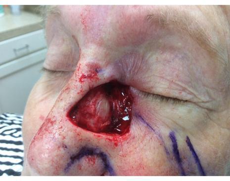 Case of the Month March 2020 | Pine Belt Dermatology
