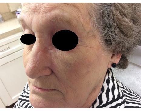 Fully Healed Wound | Pine Belt Dermatology