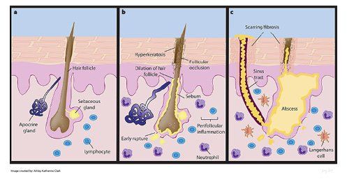 Hidradenitis Suppurativa | Pine Belt Dermatology