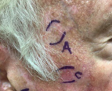 Marking the affected area | Pine Belt Dermatology