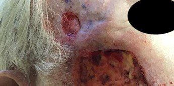 Basal Cell Carcinoma | First Visit | Pine Belt Dermatology