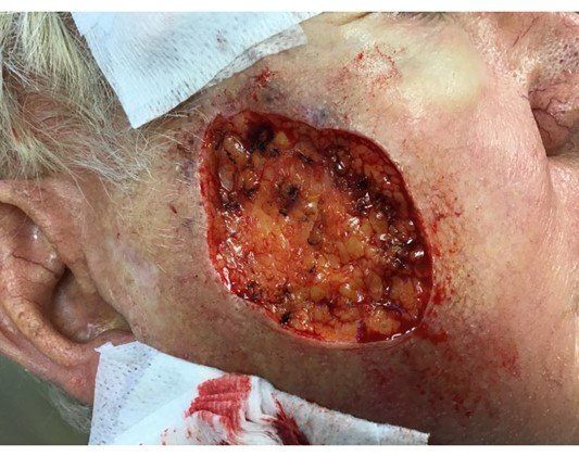 Case of the  month | Basal Cell Carcinoma - open Wound | Pine Belt Dermatology