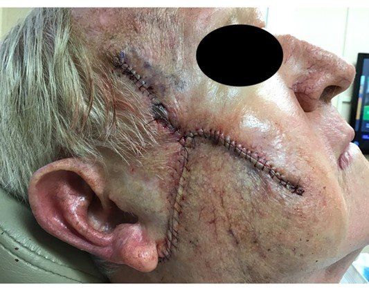 Stitches after surgery | Pine Belt Dermatology