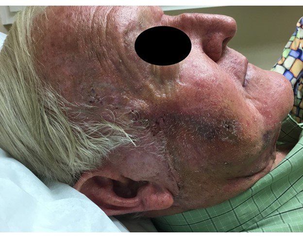 Healing After Surgery | Pine Belt Dermatology