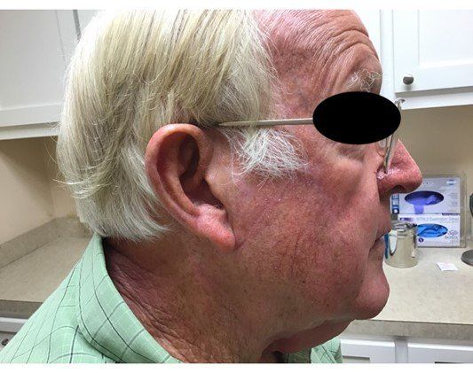 Healed after surgery | Pine Belt Dermatology