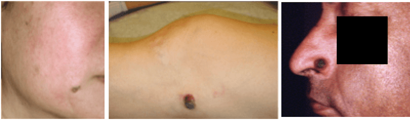 Skin Cancer on the Foot | Pine Belt Dermatology