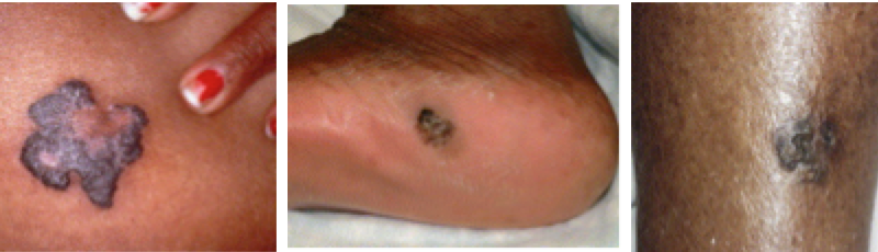 Skin Cancer in Patients | Pine Belt Dermatology