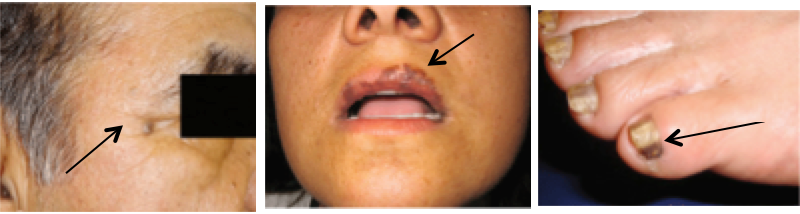 Skin Cancer on Lips | Pine Belt Dermatology