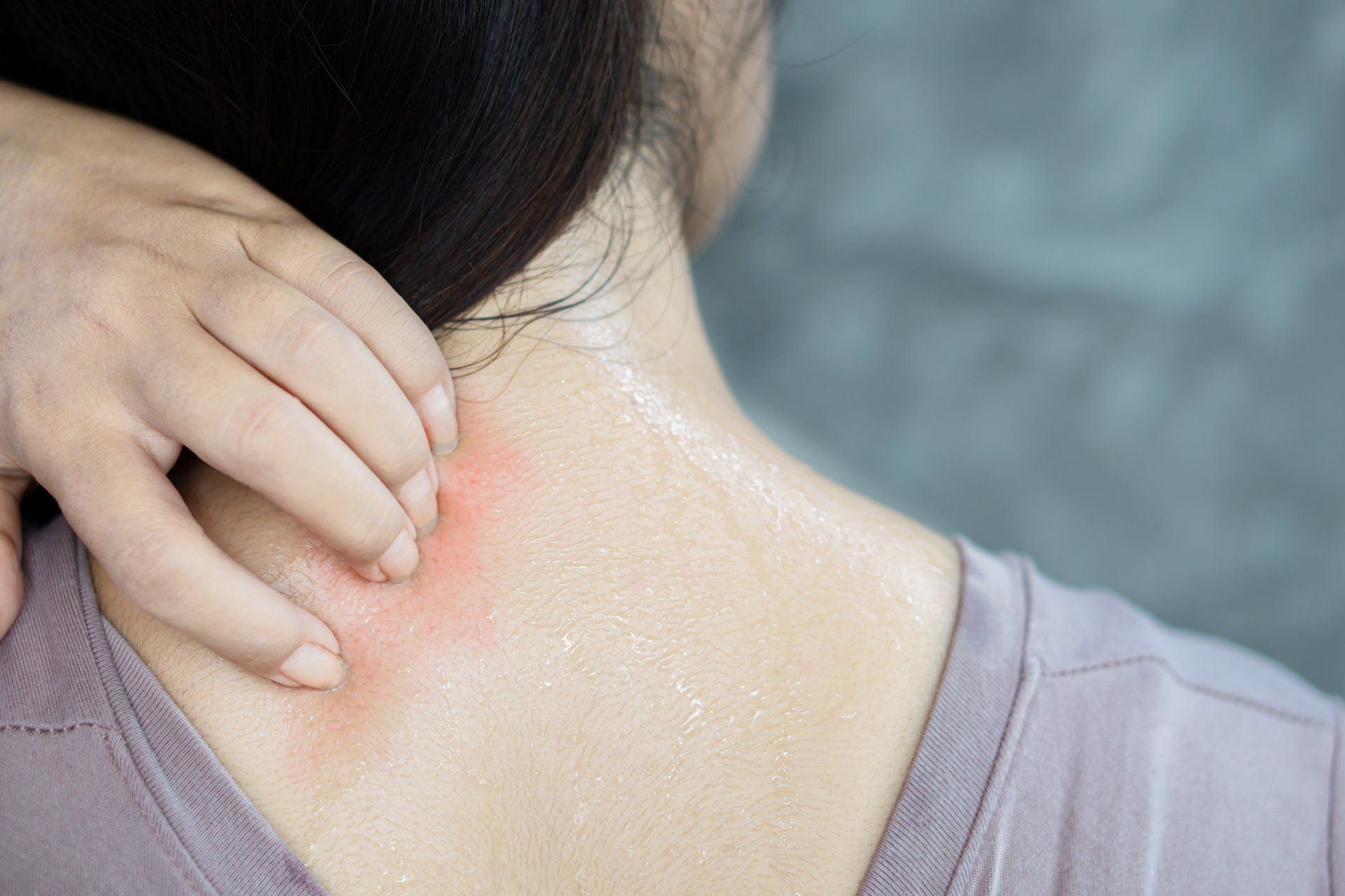 A person with psoriasis